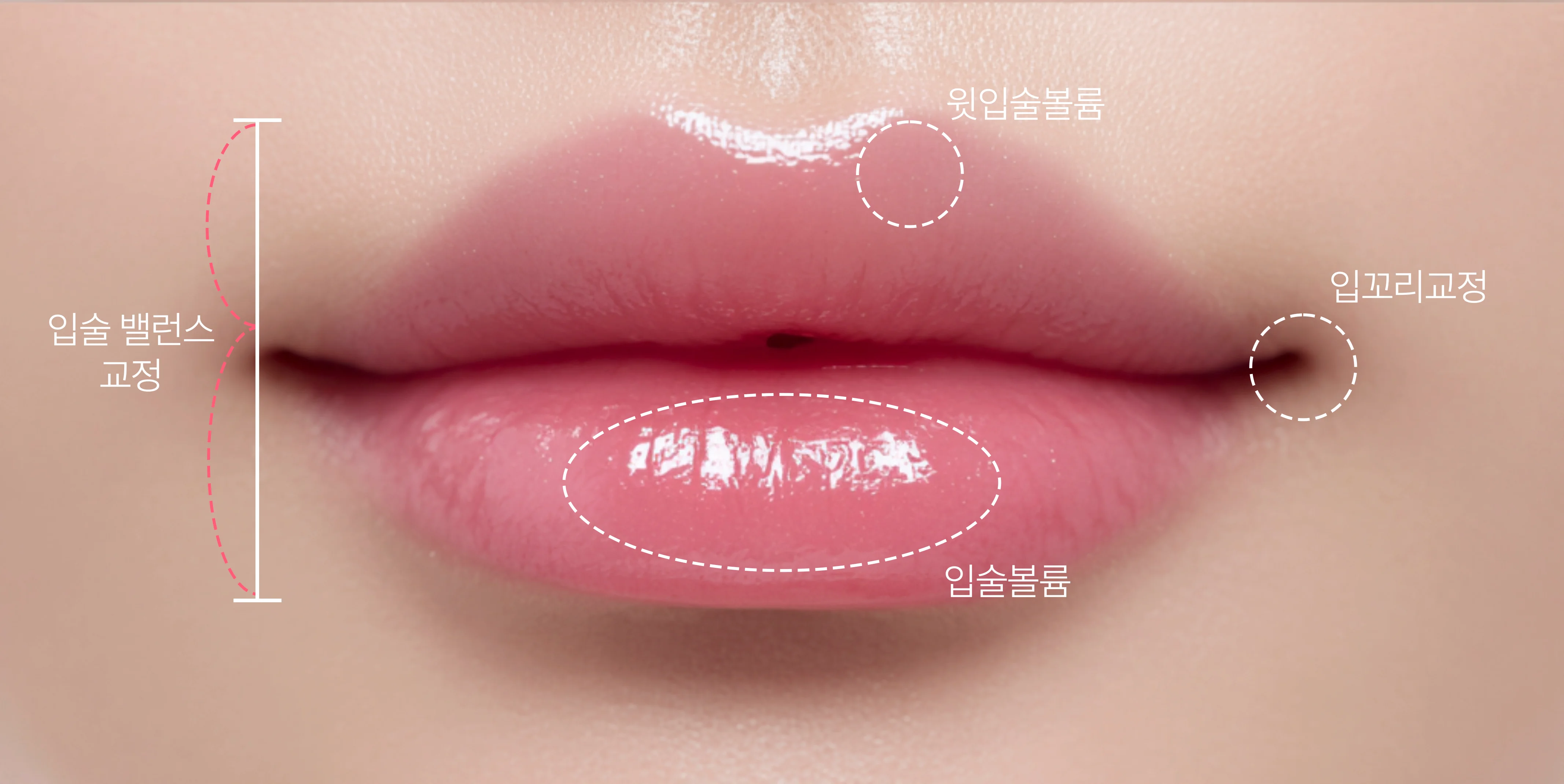 입술 밸런스 교정, 윗입술 볼륨, 입술 볼륨, 입꼬리 교정 포인트를 표시한 입술 사진
