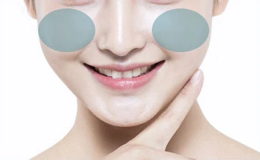 앞광대/ 인디언주름 시술 부위