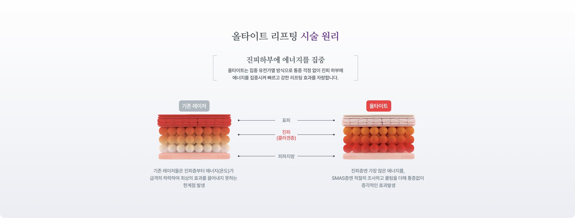 올타이트 리프팅 시술 원리